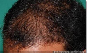 Hair restoration procedure results