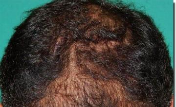 Hair restoration procedure results