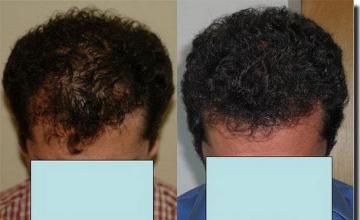 Hair restoration procedure results