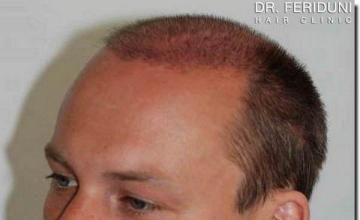 Hair restoration procedure results