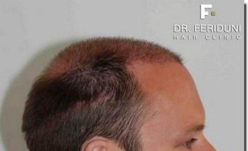 Hair restoration procedure results