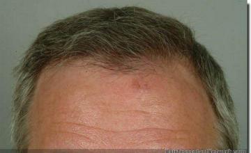 Hair restoration procedure results