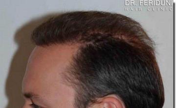 Hair restoration procedure results