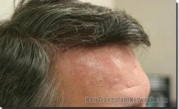 Hair restoration procedure results