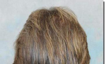 Hair restoration procedure results