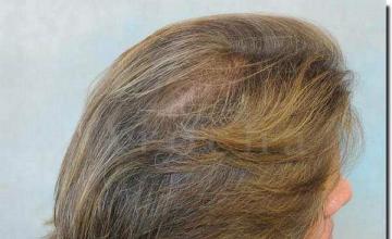 Hair restoration procedure results