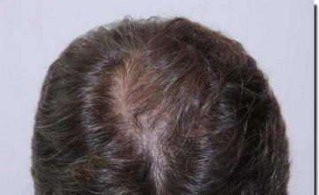 Hair restoration procedure results