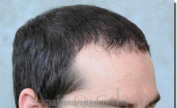 Hair restoration procedure results