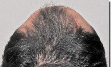 Hair restoration procedure results