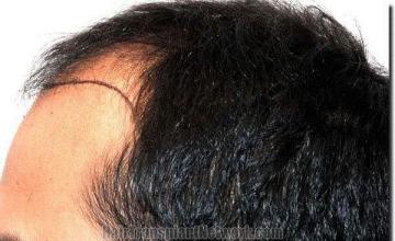 Hair restoration procedure results