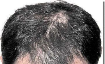 Hair restoration procedure results