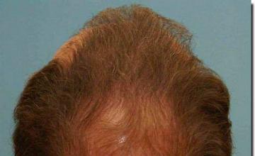 Hair restoration procedure results