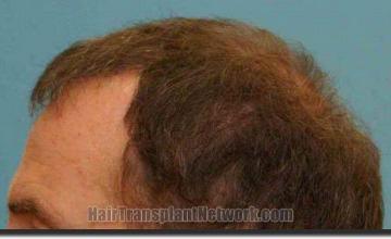 Hair restoration procedure results