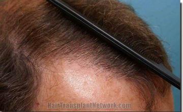 Hair restoration procedure results