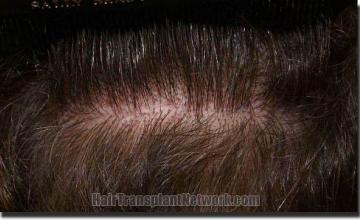 Hair restoration procedure results