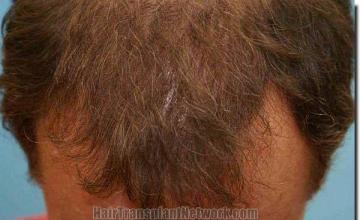 Hair restoration procedure results