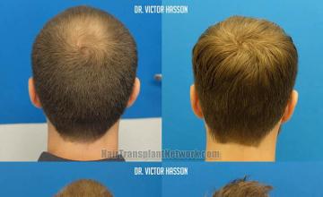 Back view before and after hair transplantation photos