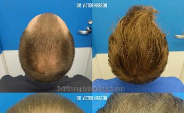 Hair transplant surgery before and after pictures