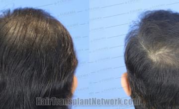 Back view before and after hair transplantation 