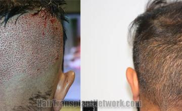 Back view before and after hair transplantation 