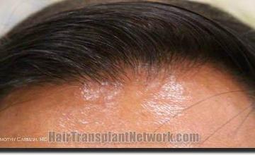 Hair restoration procedure results