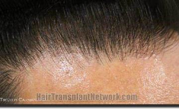 Hair restoration procedure results