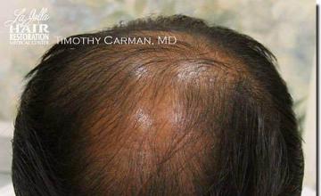 Hair restoration procedure results