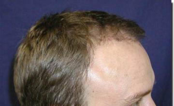 Hair restoration procedure results