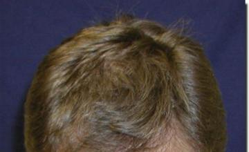 Hair restoration procedure results