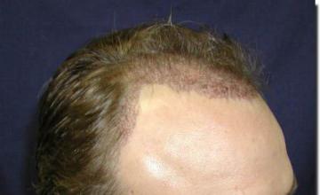 Hair restoration procedure results