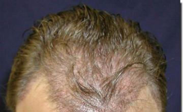 Hair restoration procedure results