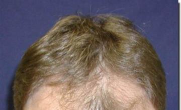 Hair restoration procedure results