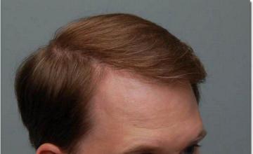 Hair restoration procedure results