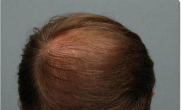 Hair restoration procedure results