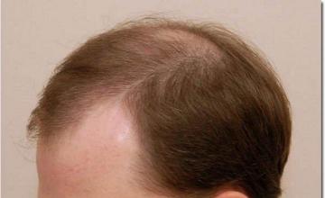 Hair restoration procedure results