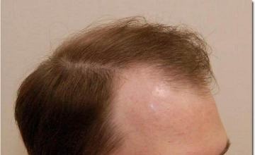 Hair restoration procedure results