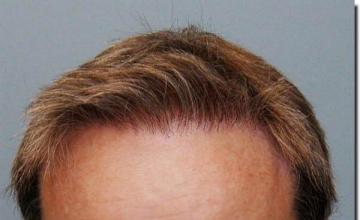 Hair restoration procedure results