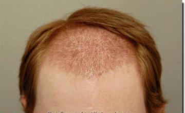 Hair restoration procedure results