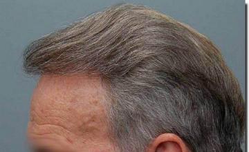 Hair restoration procedure results