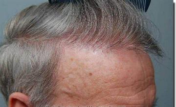 Hair restoration procedure results