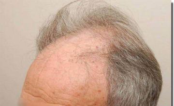 Hair restoration procedure results