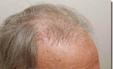 Hair restoration procedure results