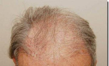 Hair restoration procedure results