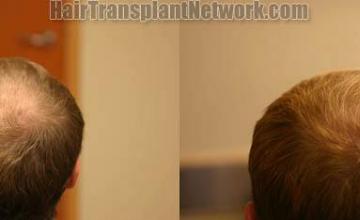 Hair transplantation surgery before and after pictures