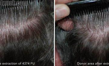 Hair restoration procedure before and after result images