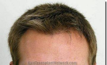 Hair restoration procedure results