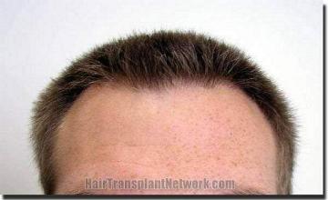 Hair restoration procedure results