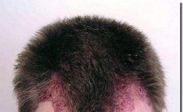 Hair restoration procedure results