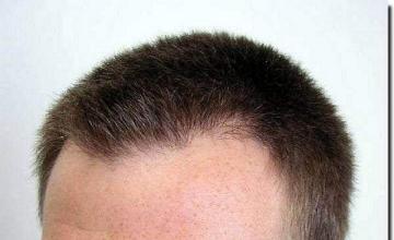 Hair restoration procedure results