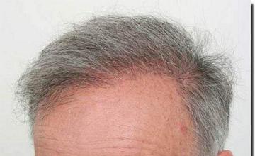 Hair restoration procedure results